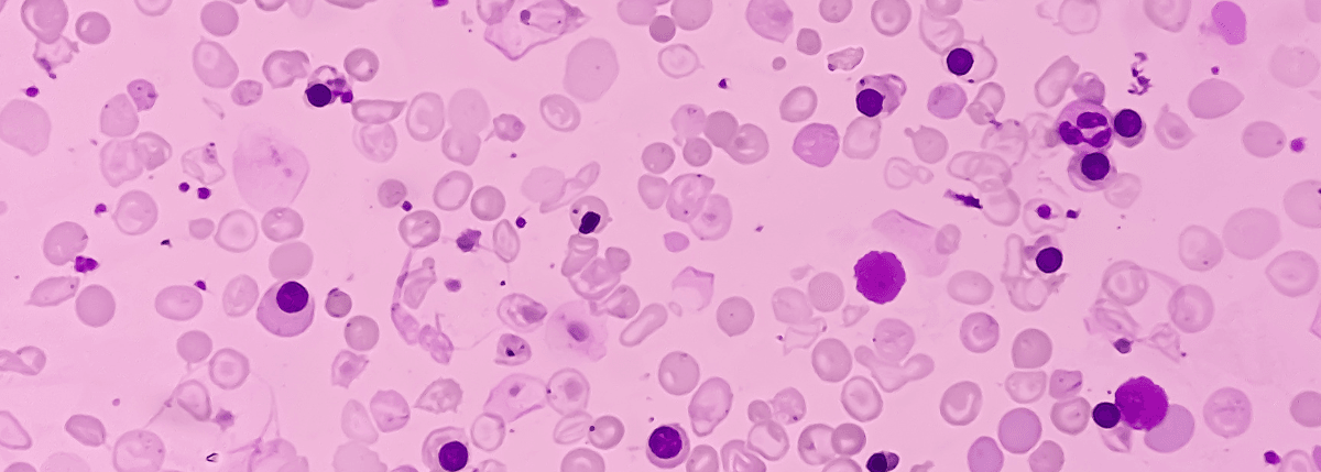 Przeciwciała przeciwplemnikowe i przeciwciała ANA vs wpływ na płodność
